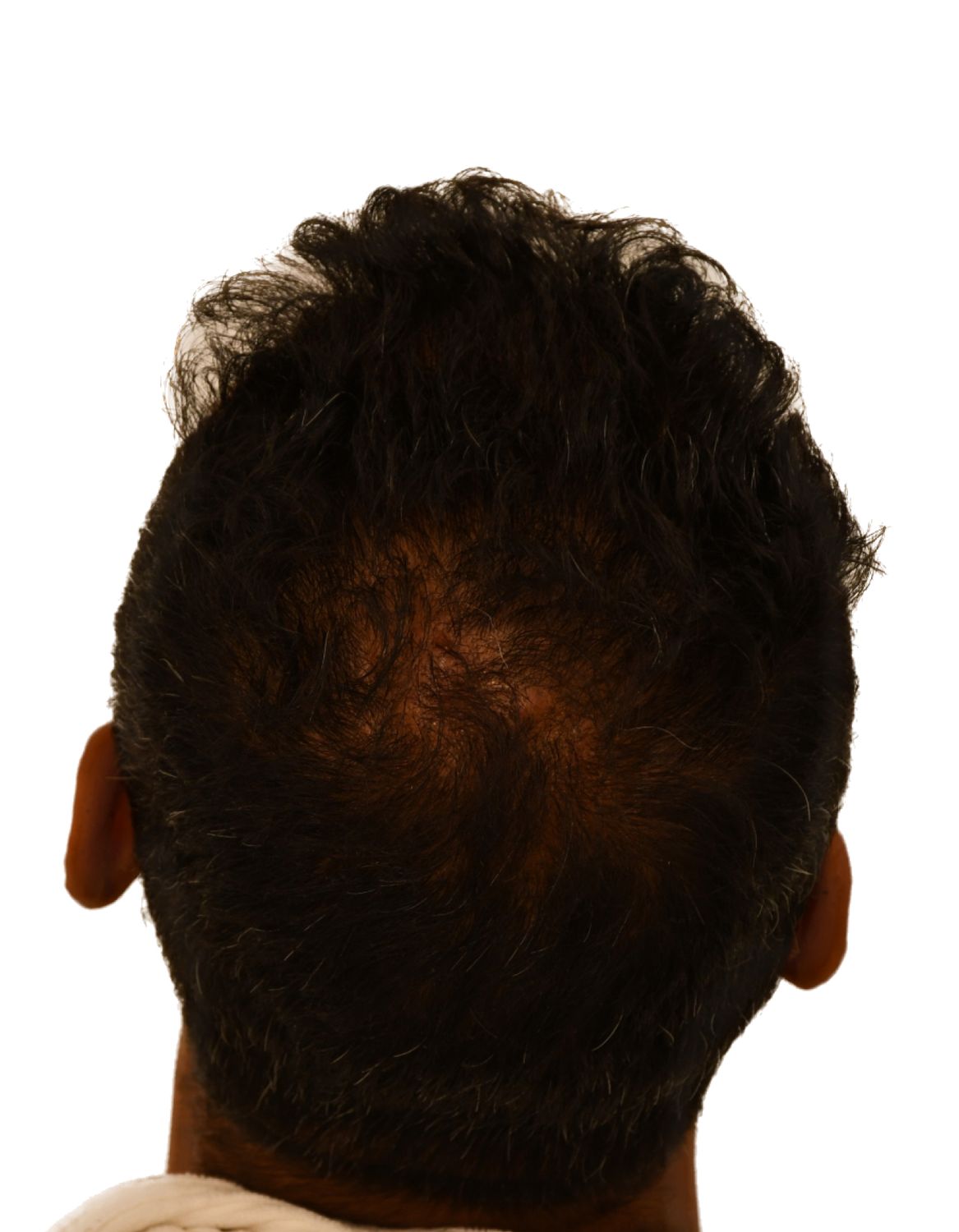 hair transplant after