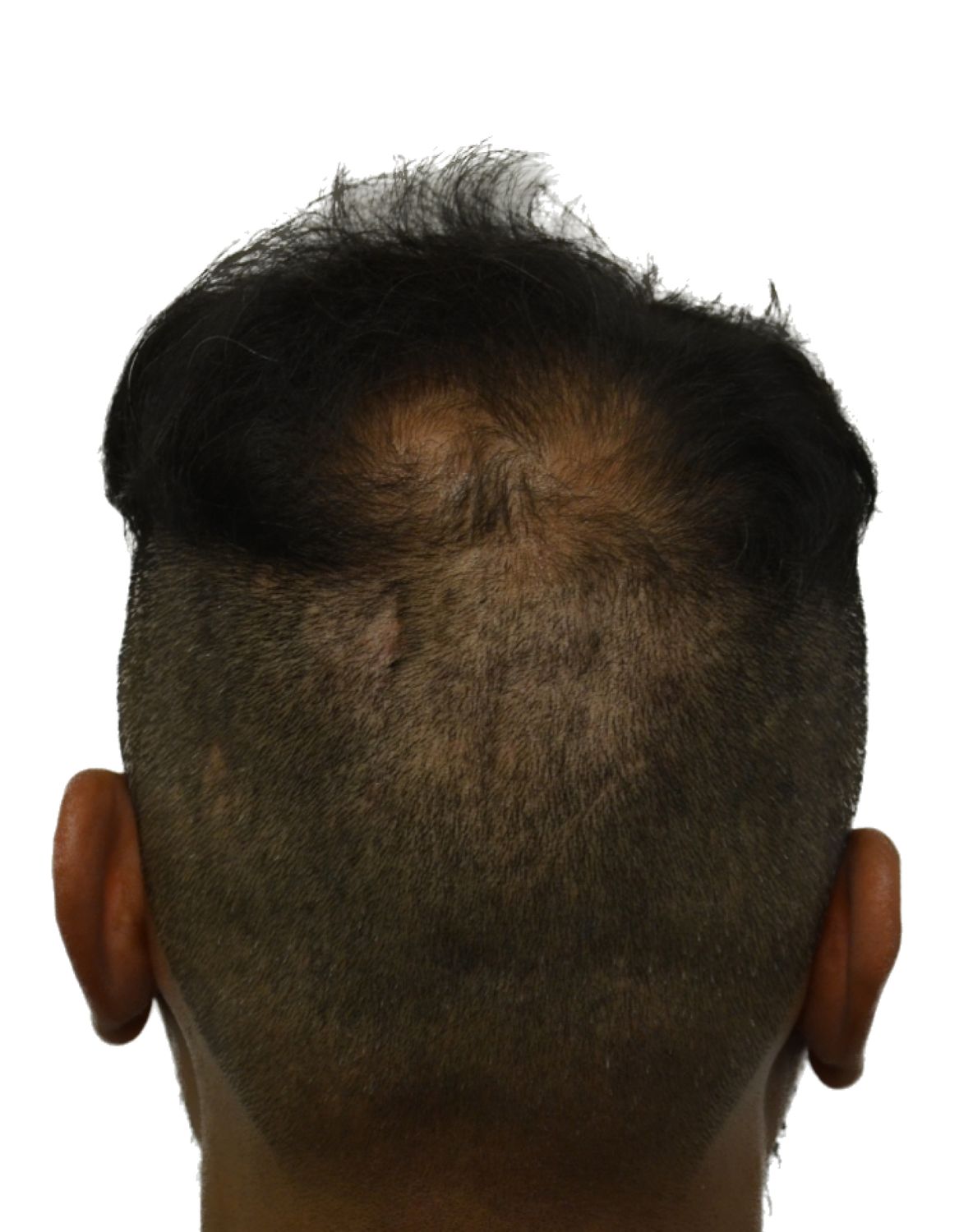 hair transplant before
