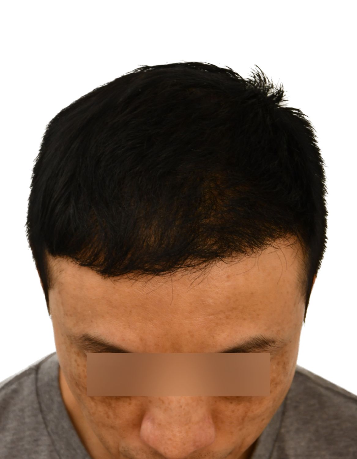 hair transplant after