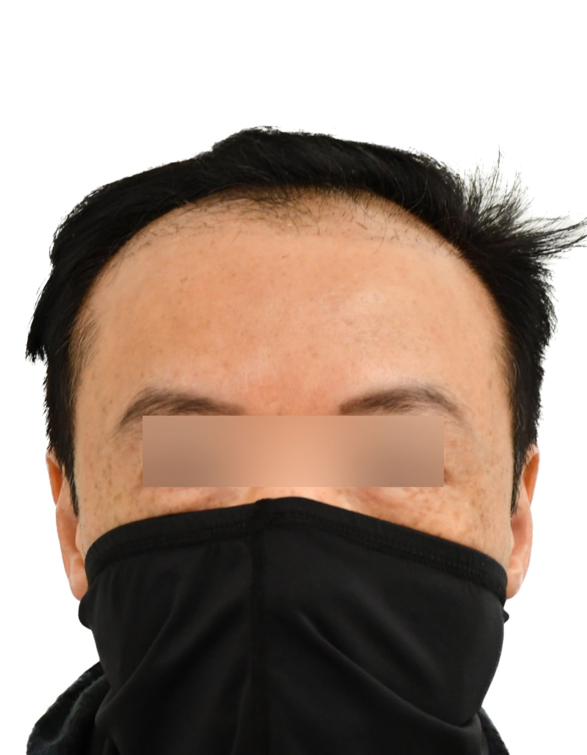 hair transplant before