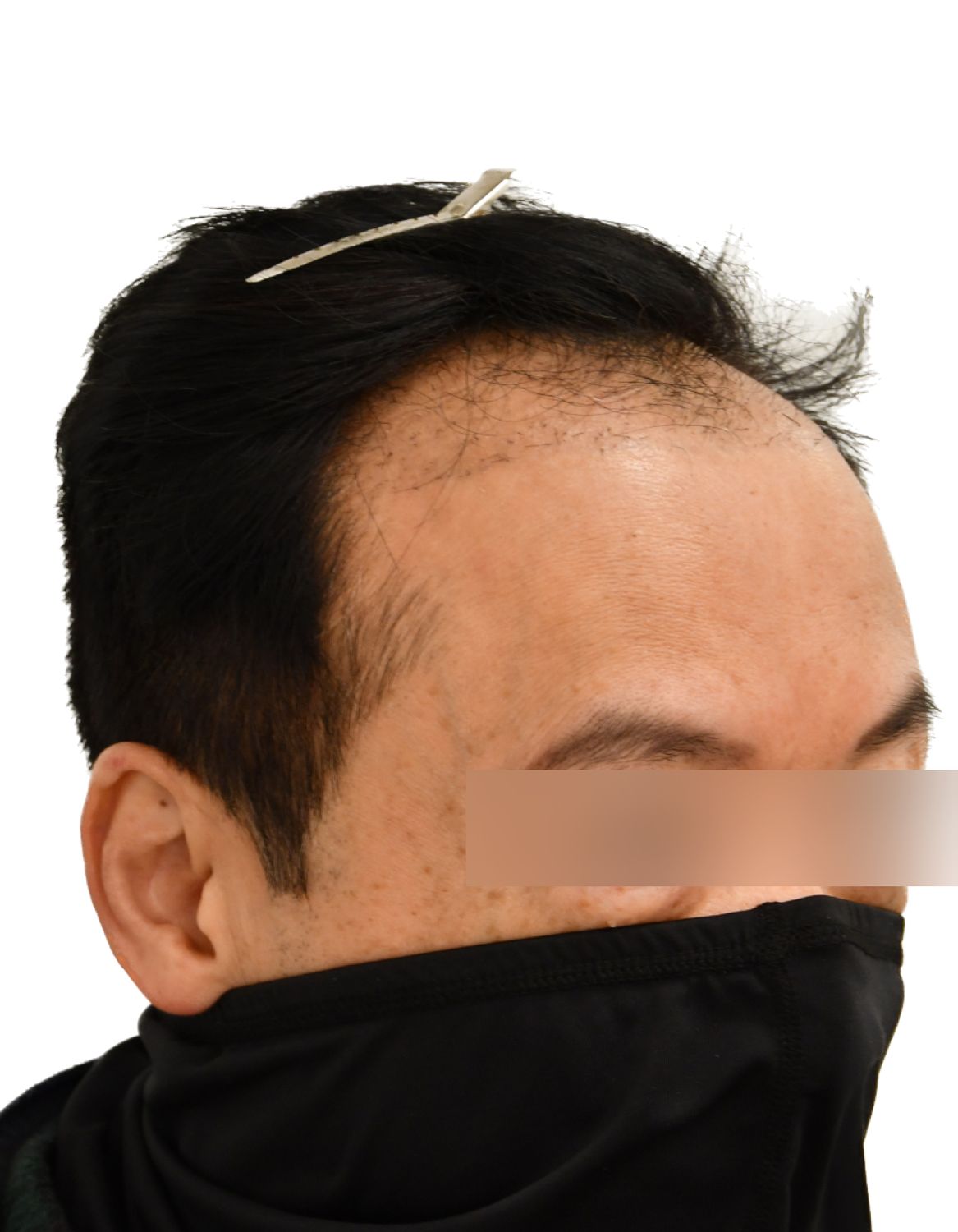 hair transplant before