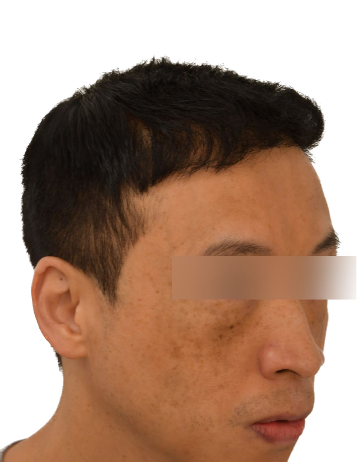 hair transplant after