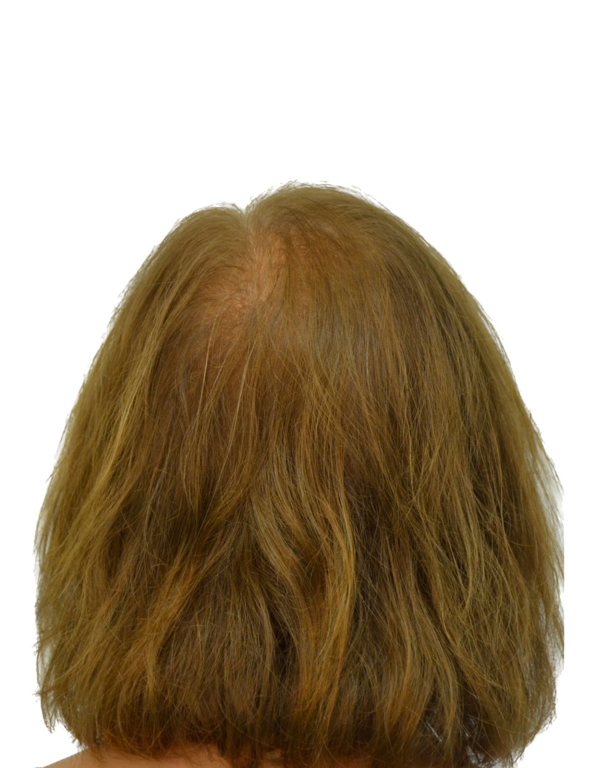 hair transplant before