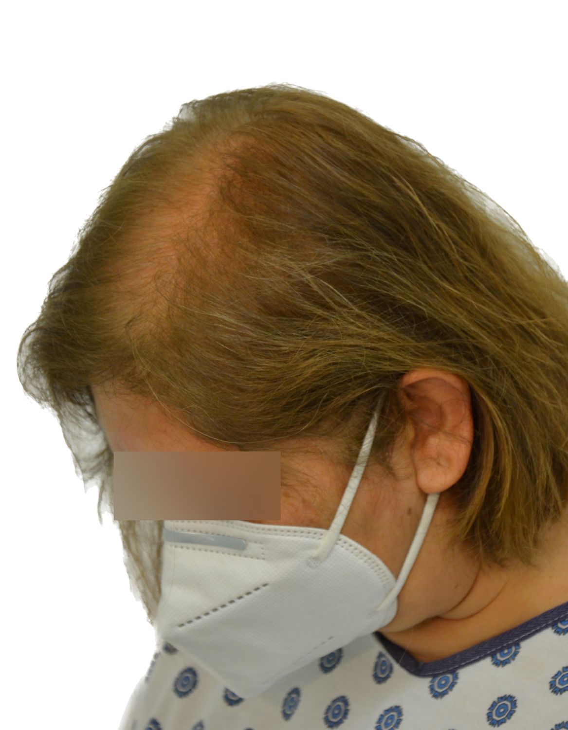 hair transplant before