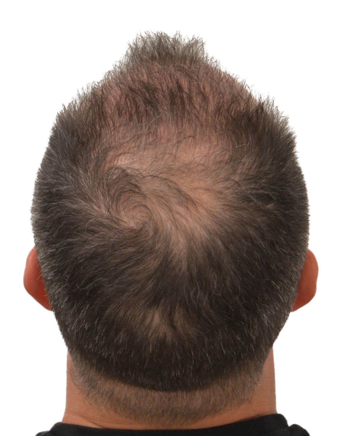 hair transplant after