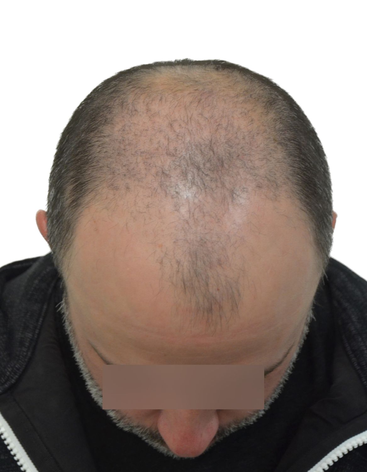 hair transplant before