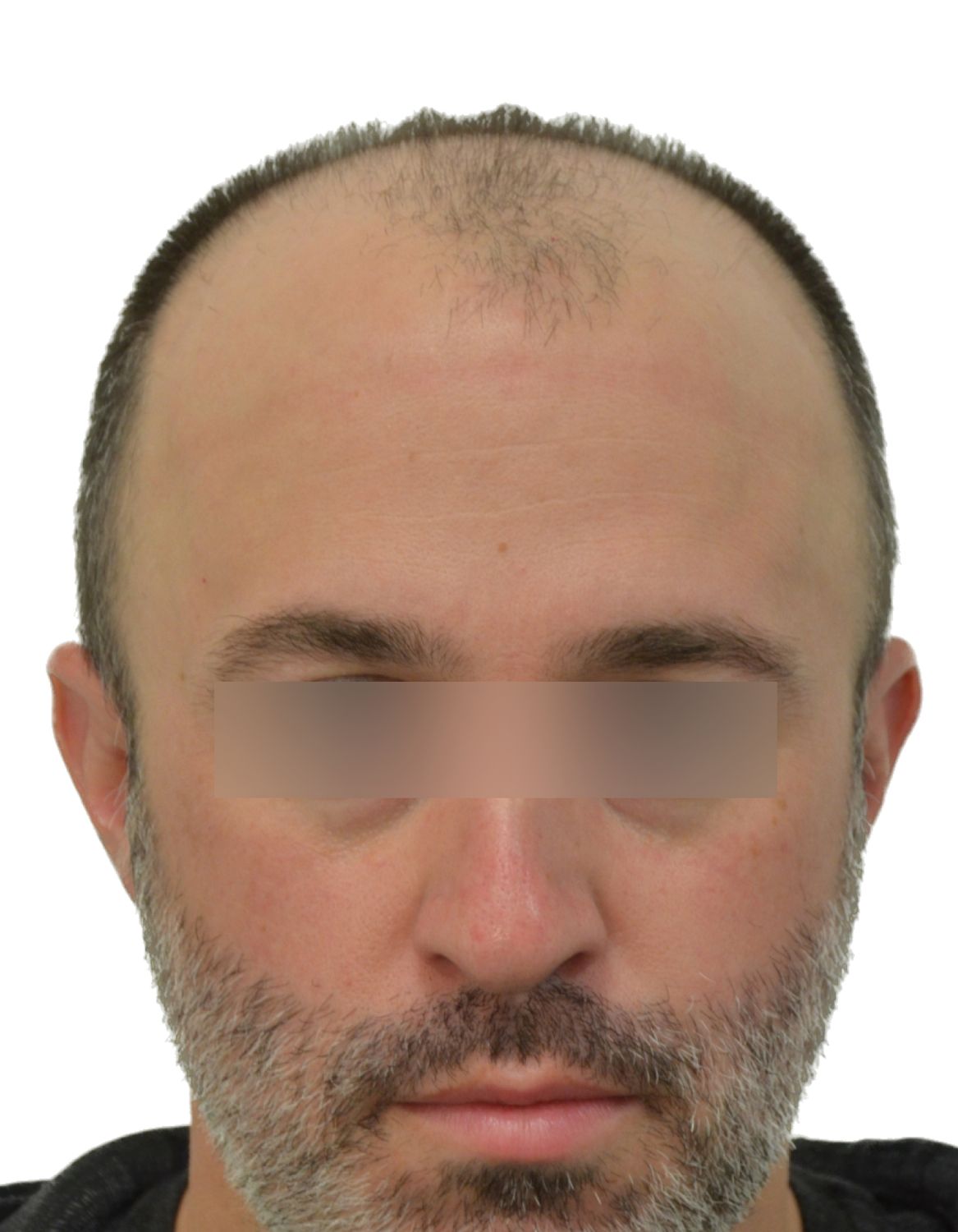 hair transplant before