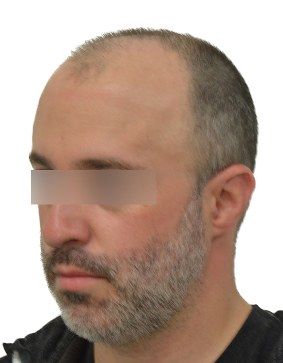 hair transplant before