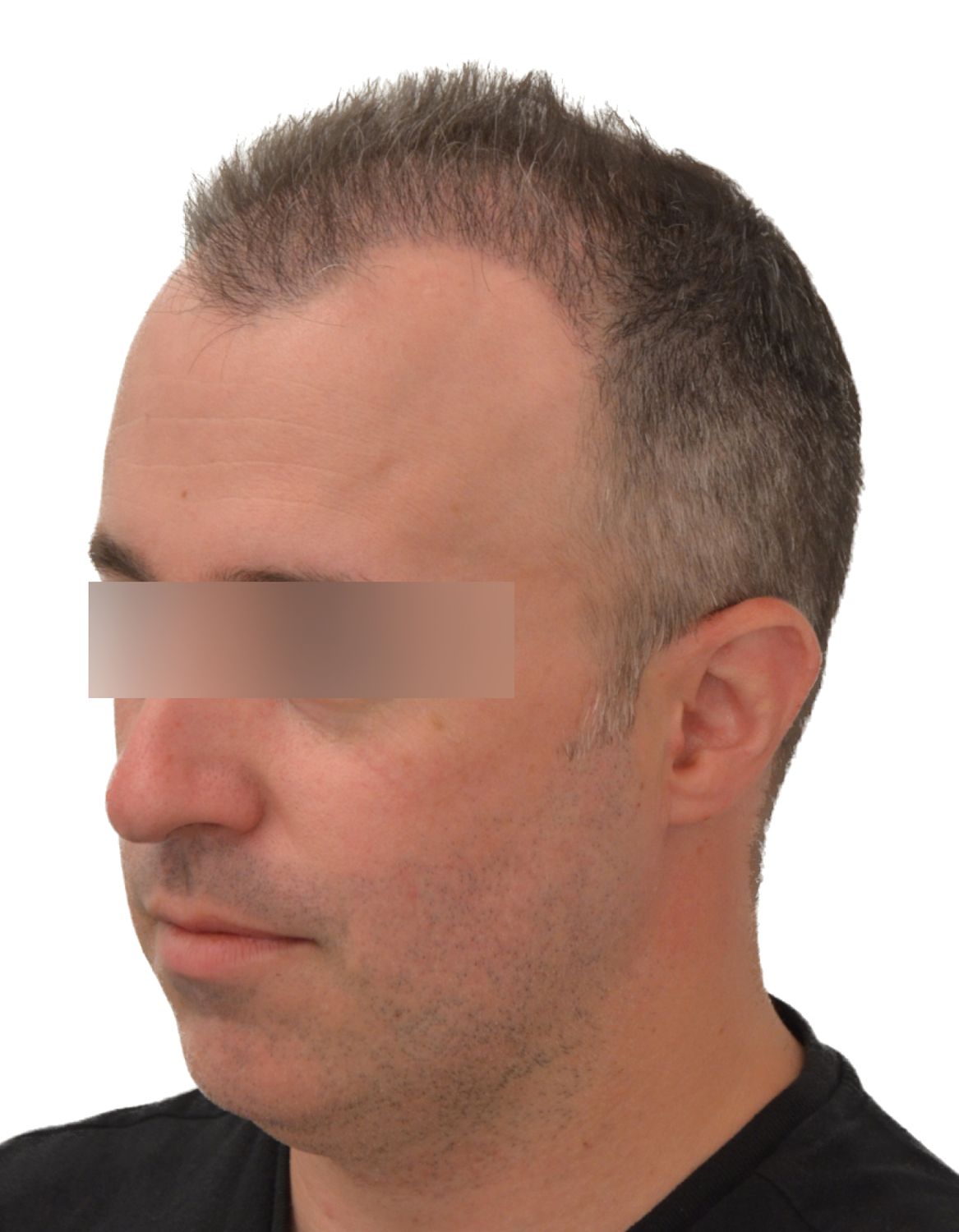 hair transplant after