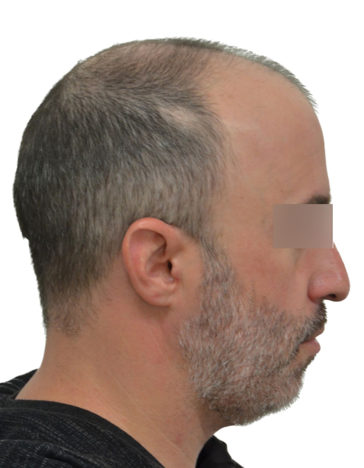 hair transplant before