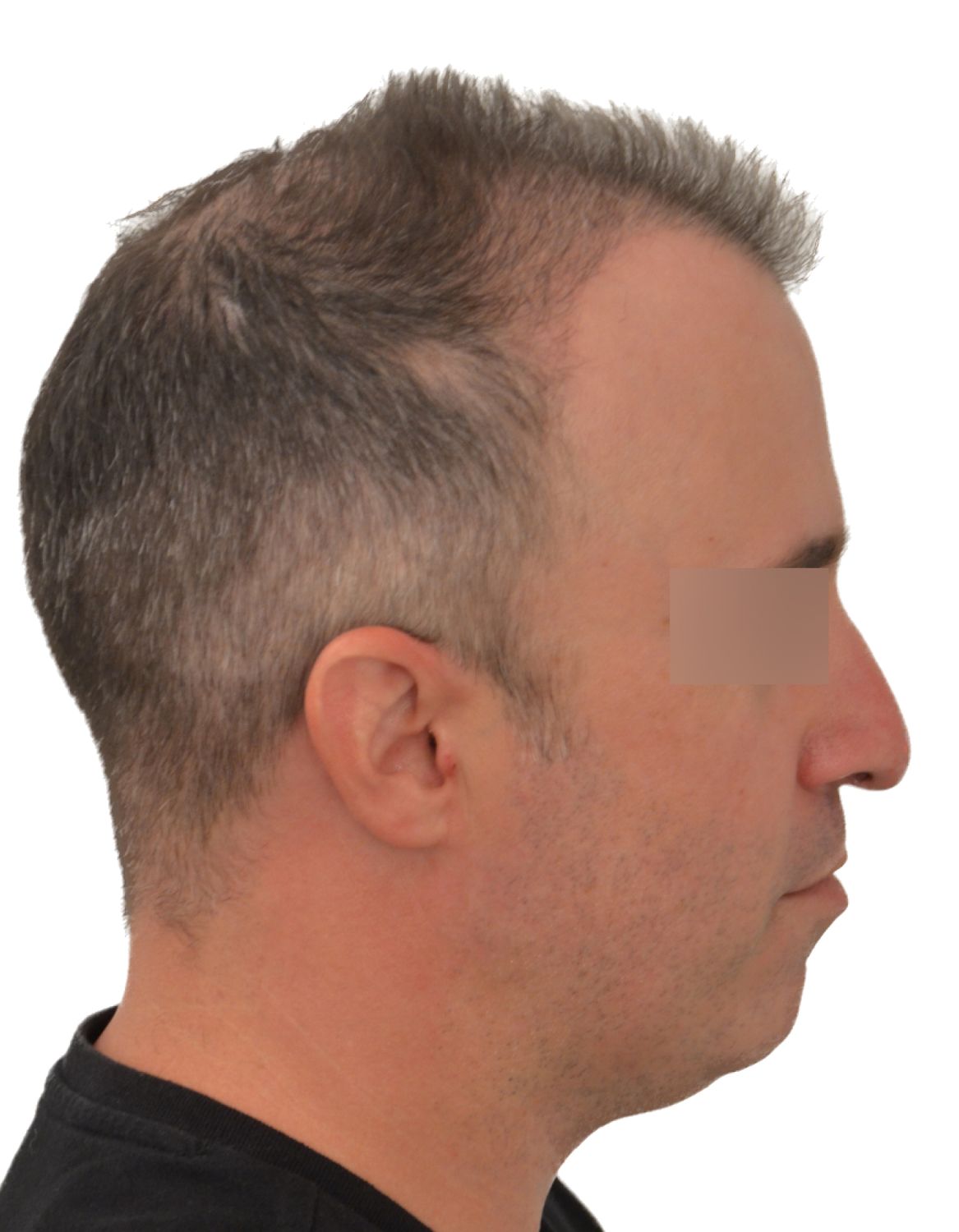 hair transplant after