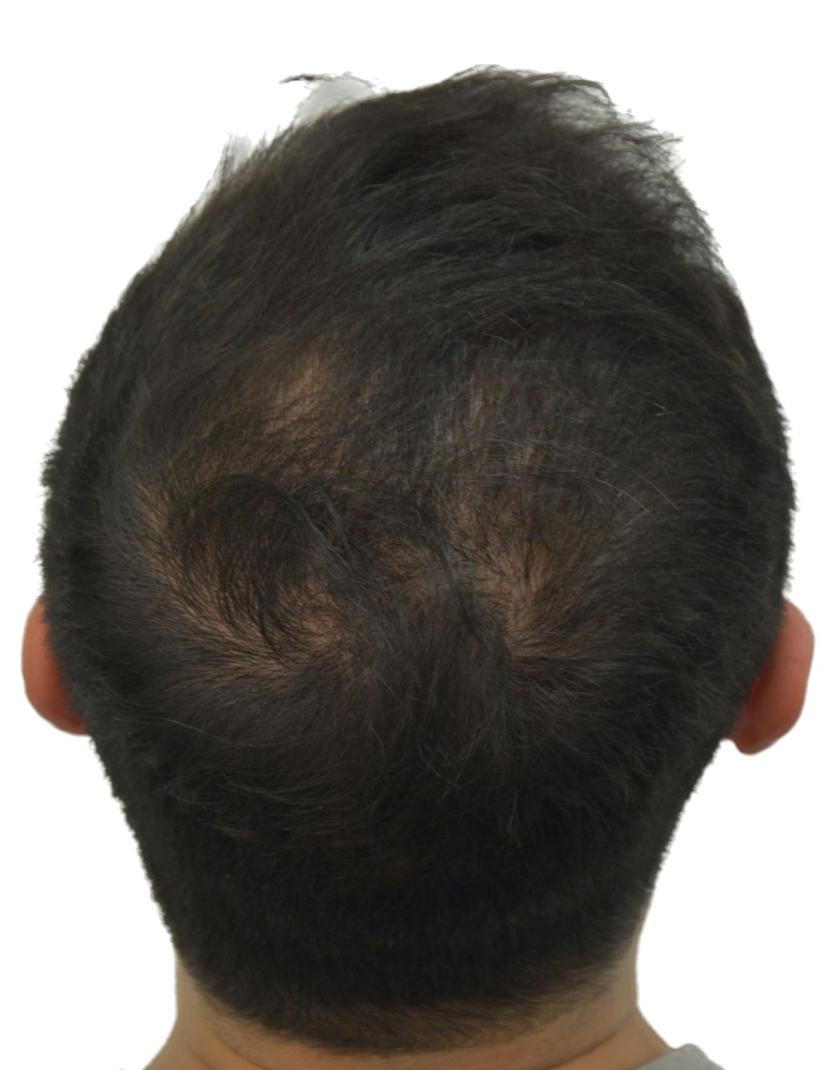 hair transplant before