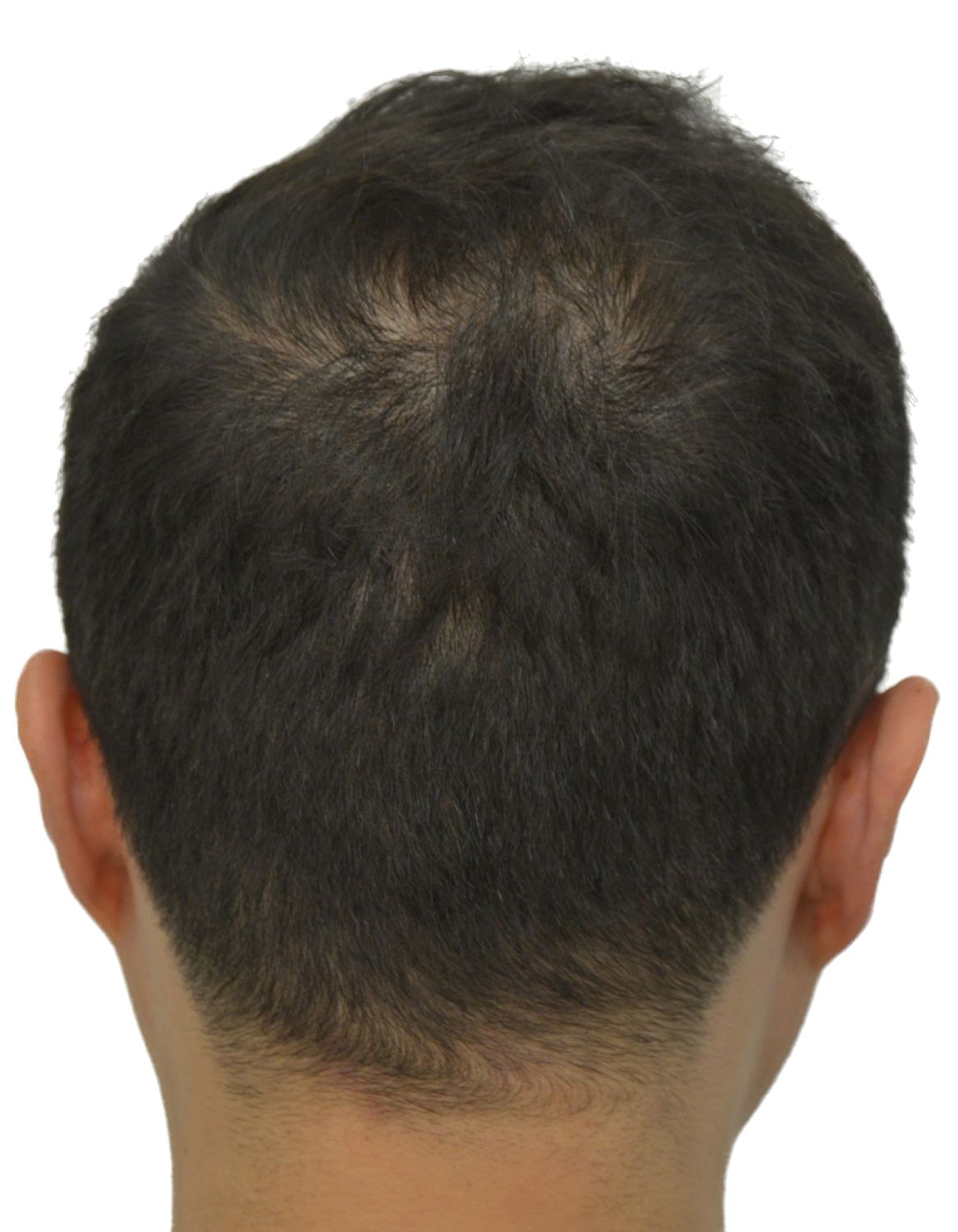 hair transplant before