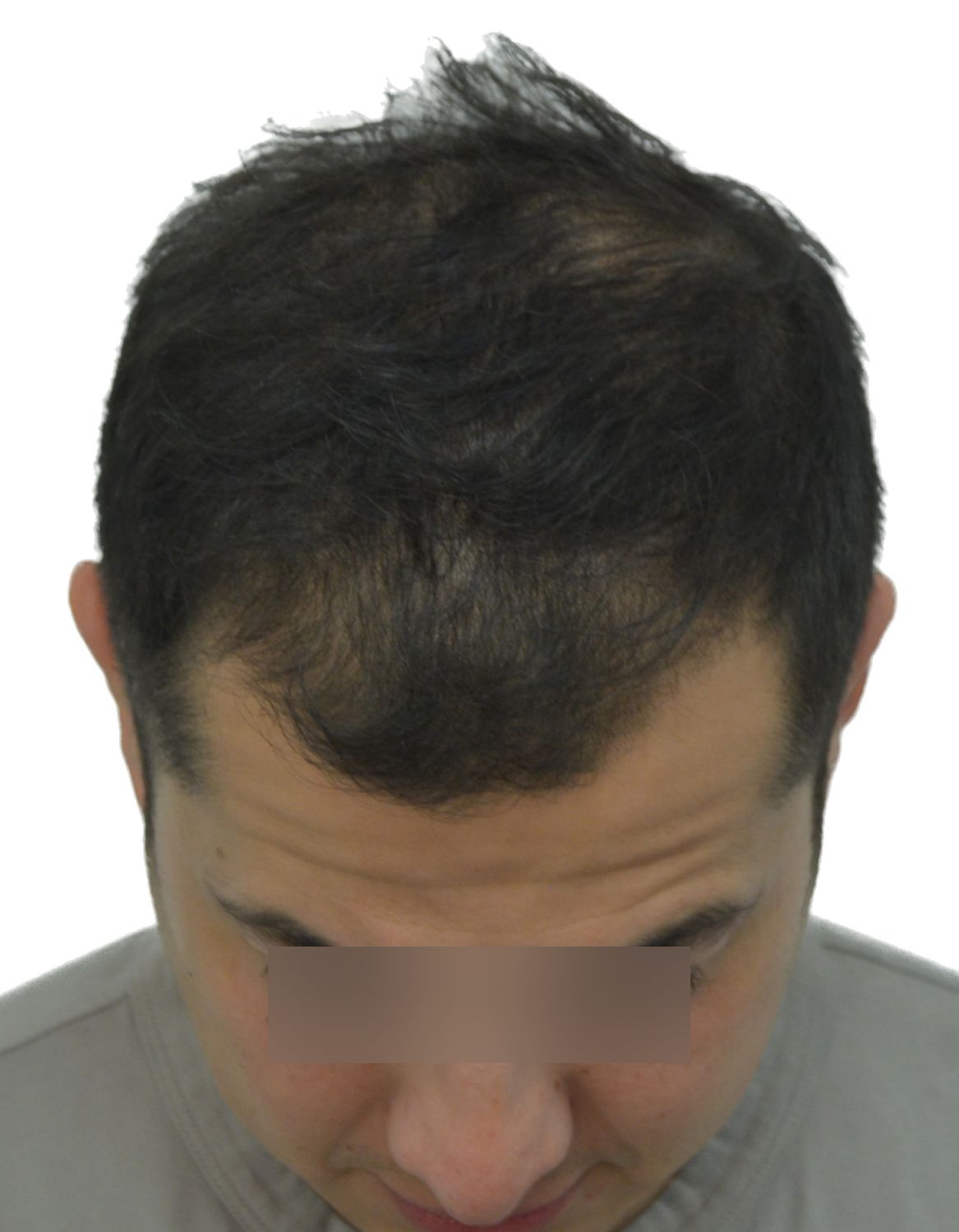 hair transplant before