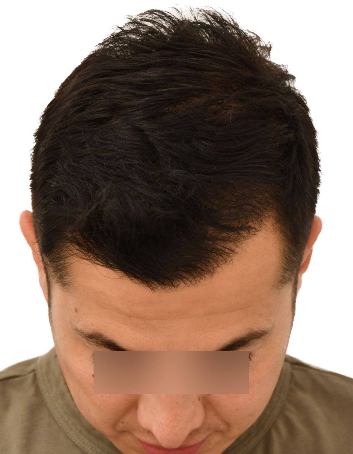 hair transplant after