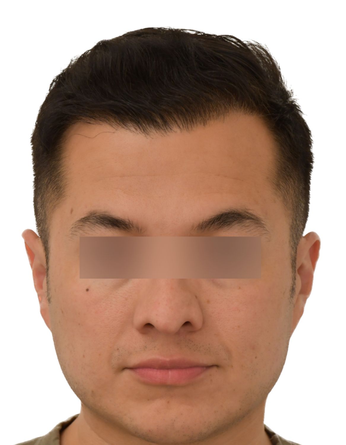 hair transplant after