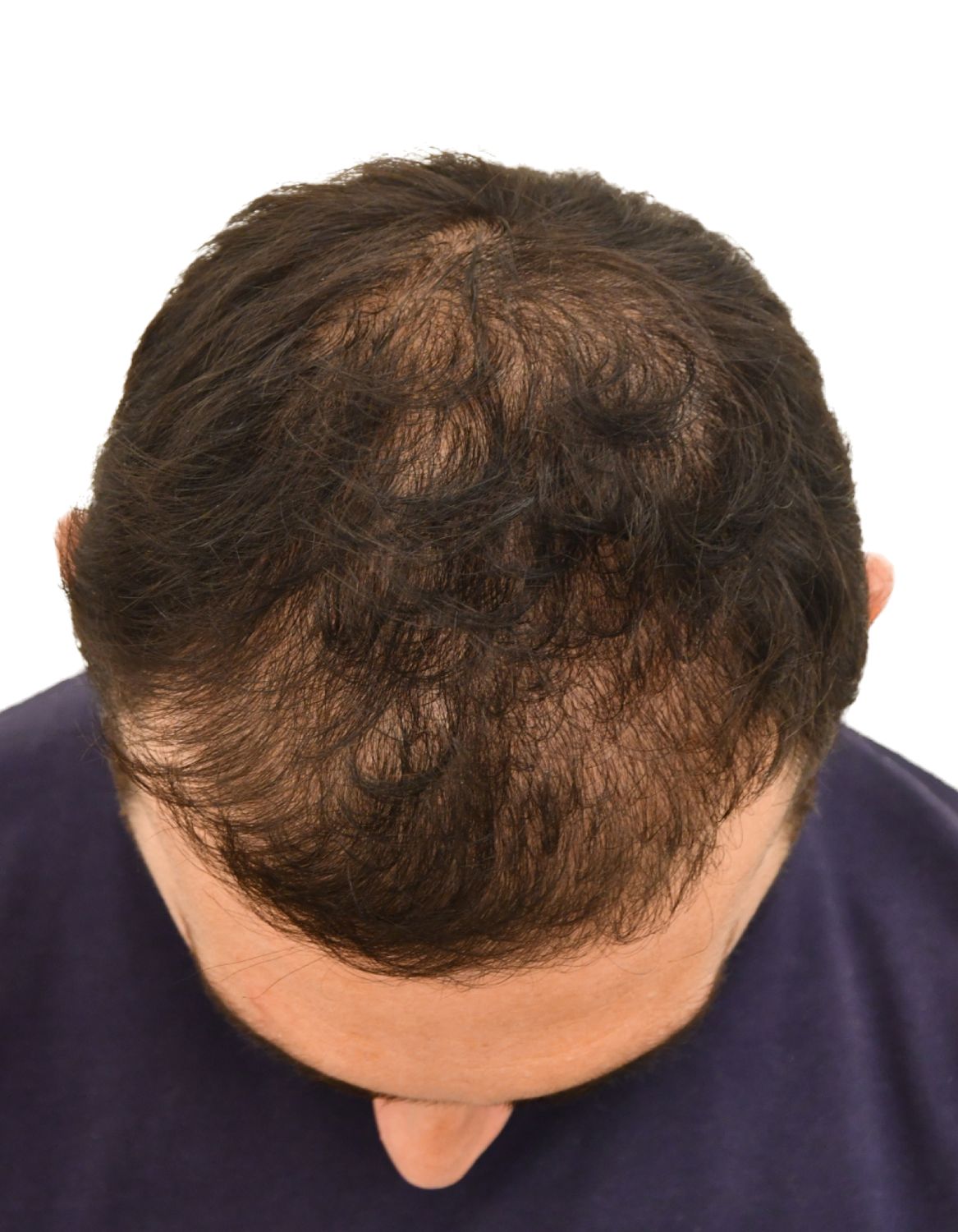 hair transplant after