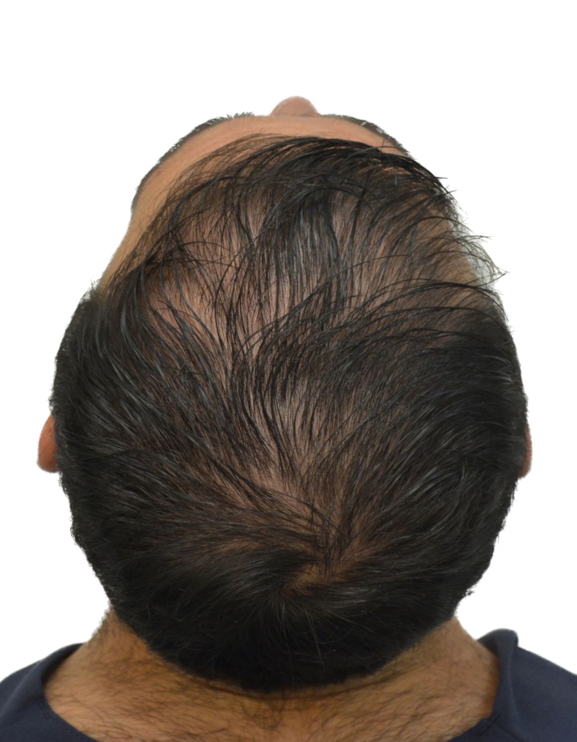 hair transplant before