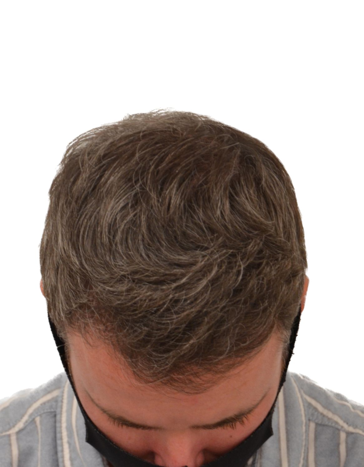 hair transplant after