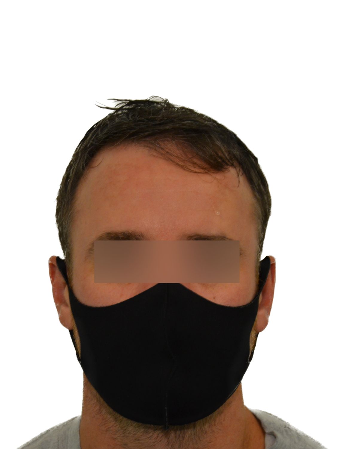 hair transplant before