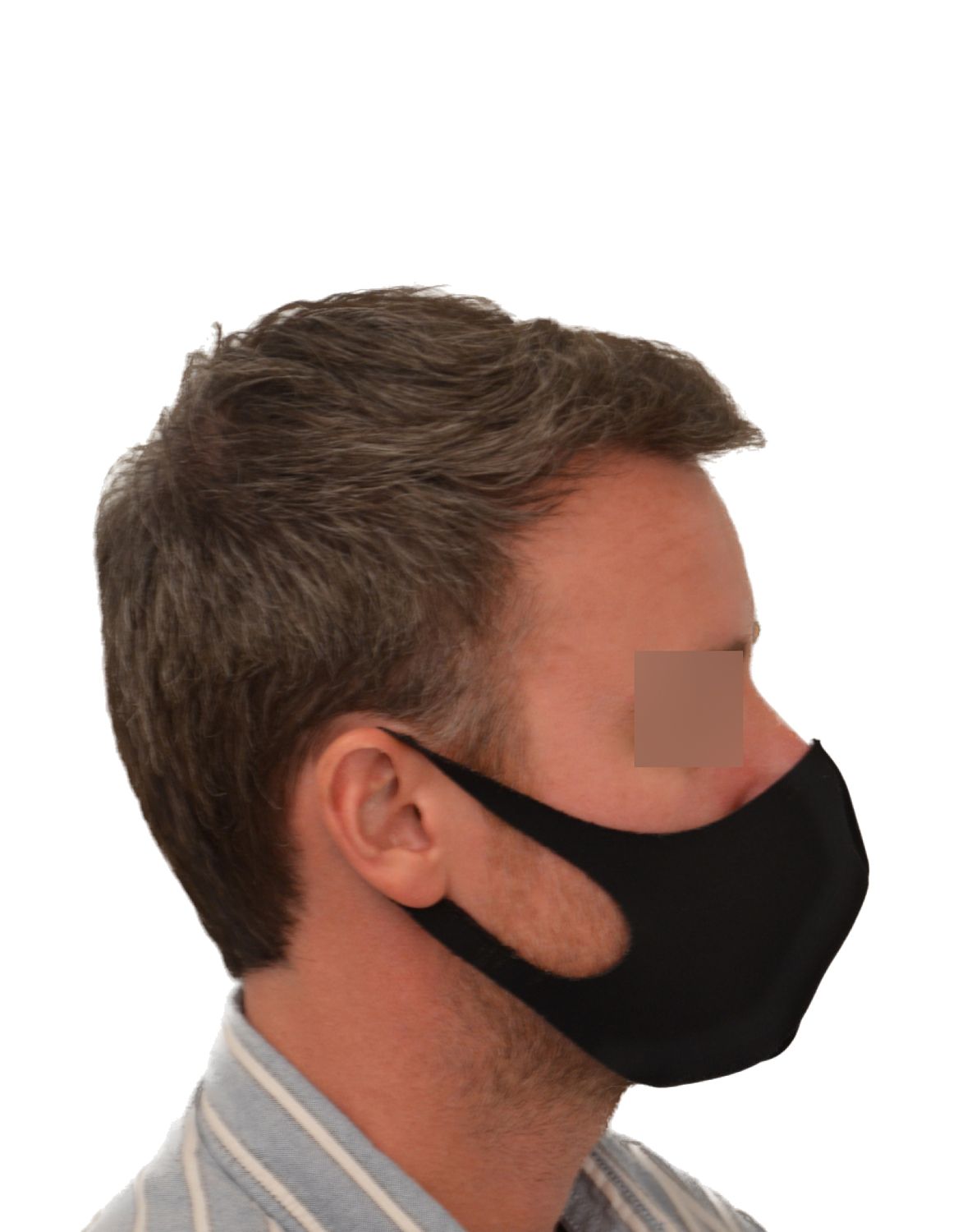 hair transplant after