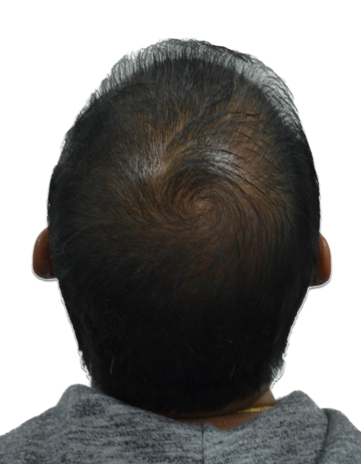 hair transplant before