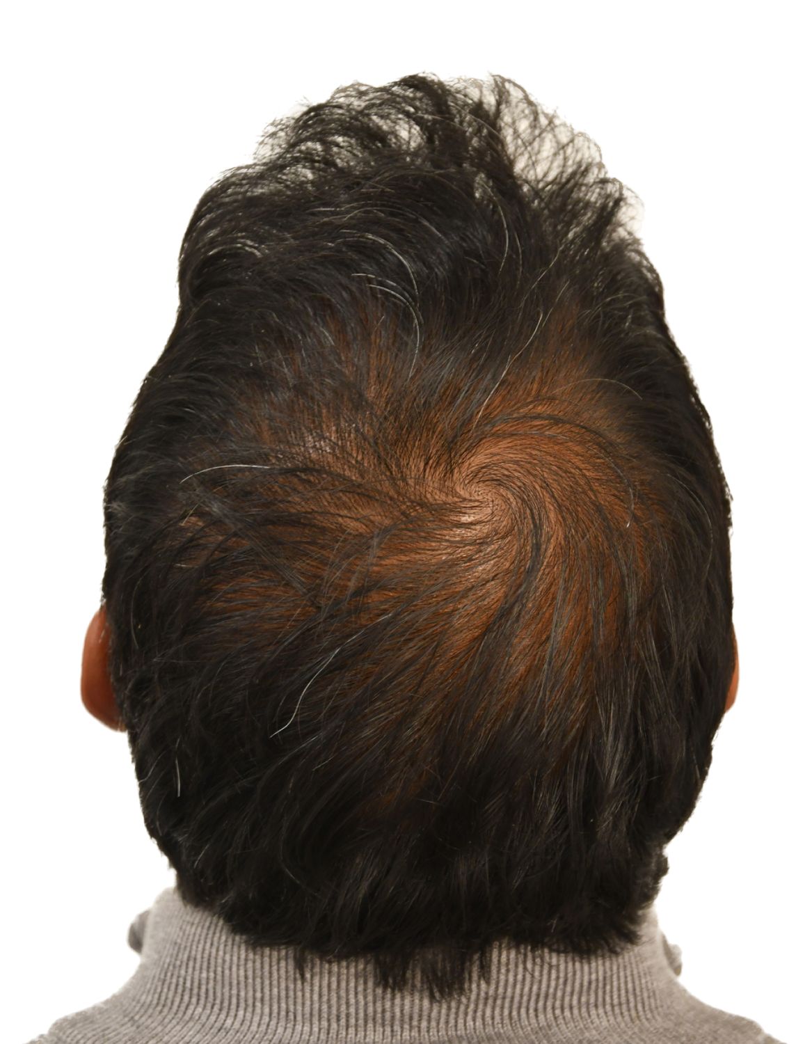 hair transplant after