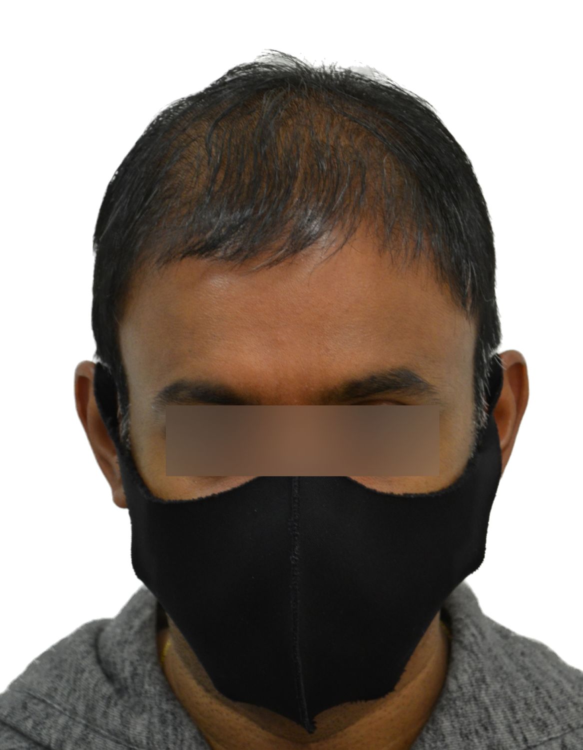 hair transplant before