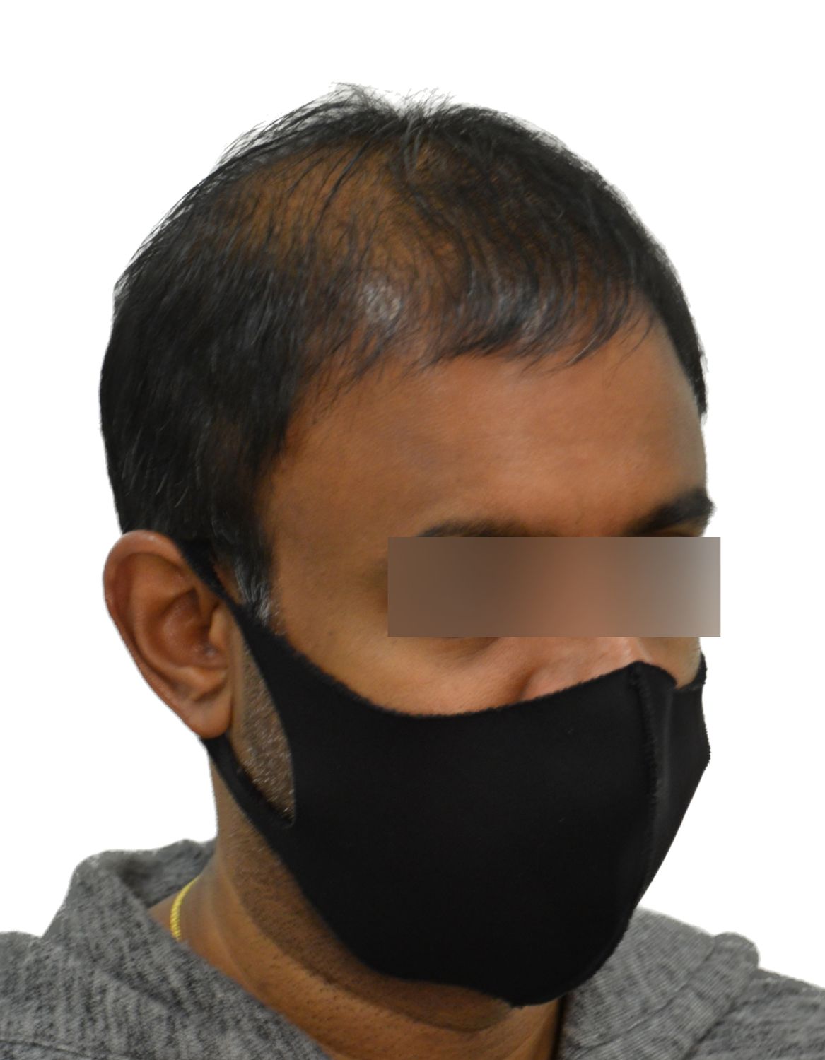 hair transplant before