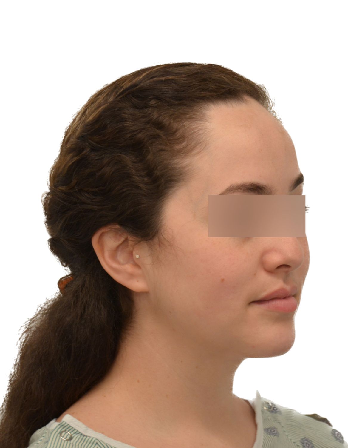 Forehead Reduction Surgery Before