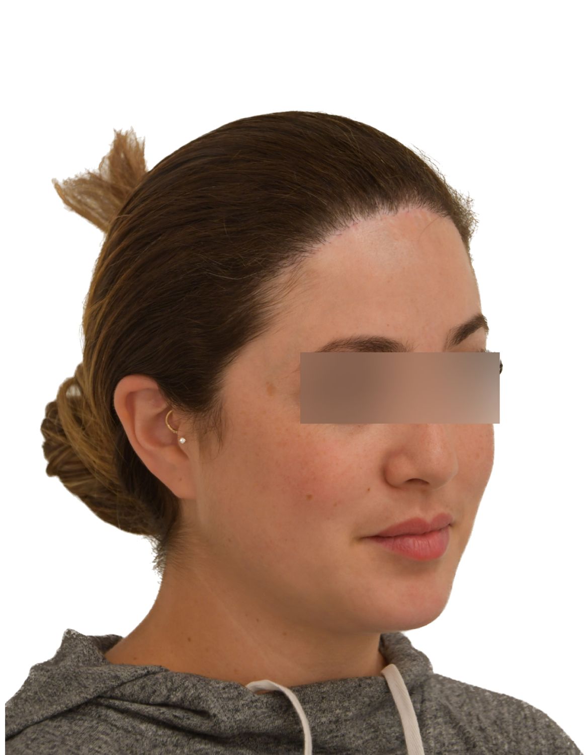 Forehead Reduction Surgery After