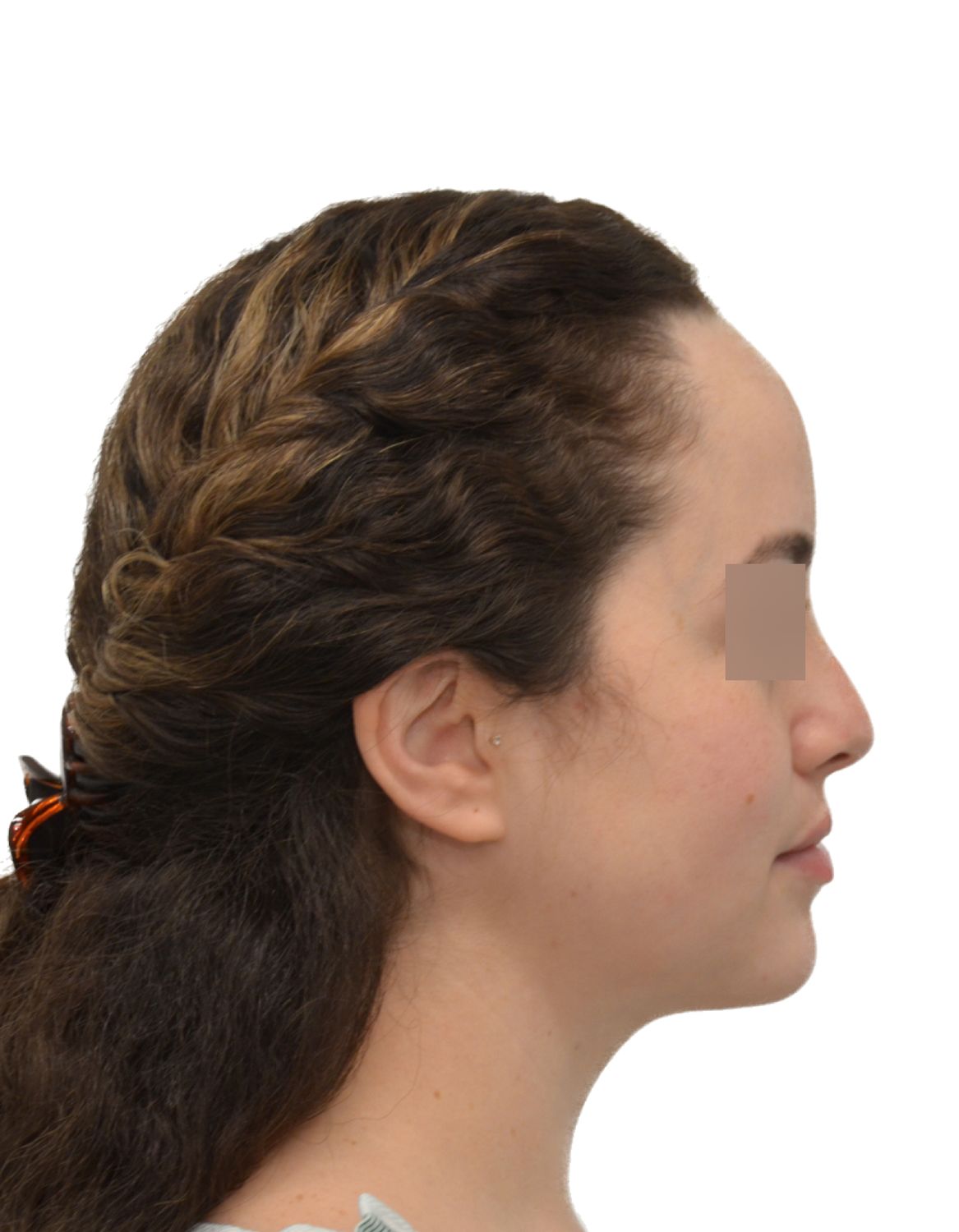 Forehead Reduction Surgery Before