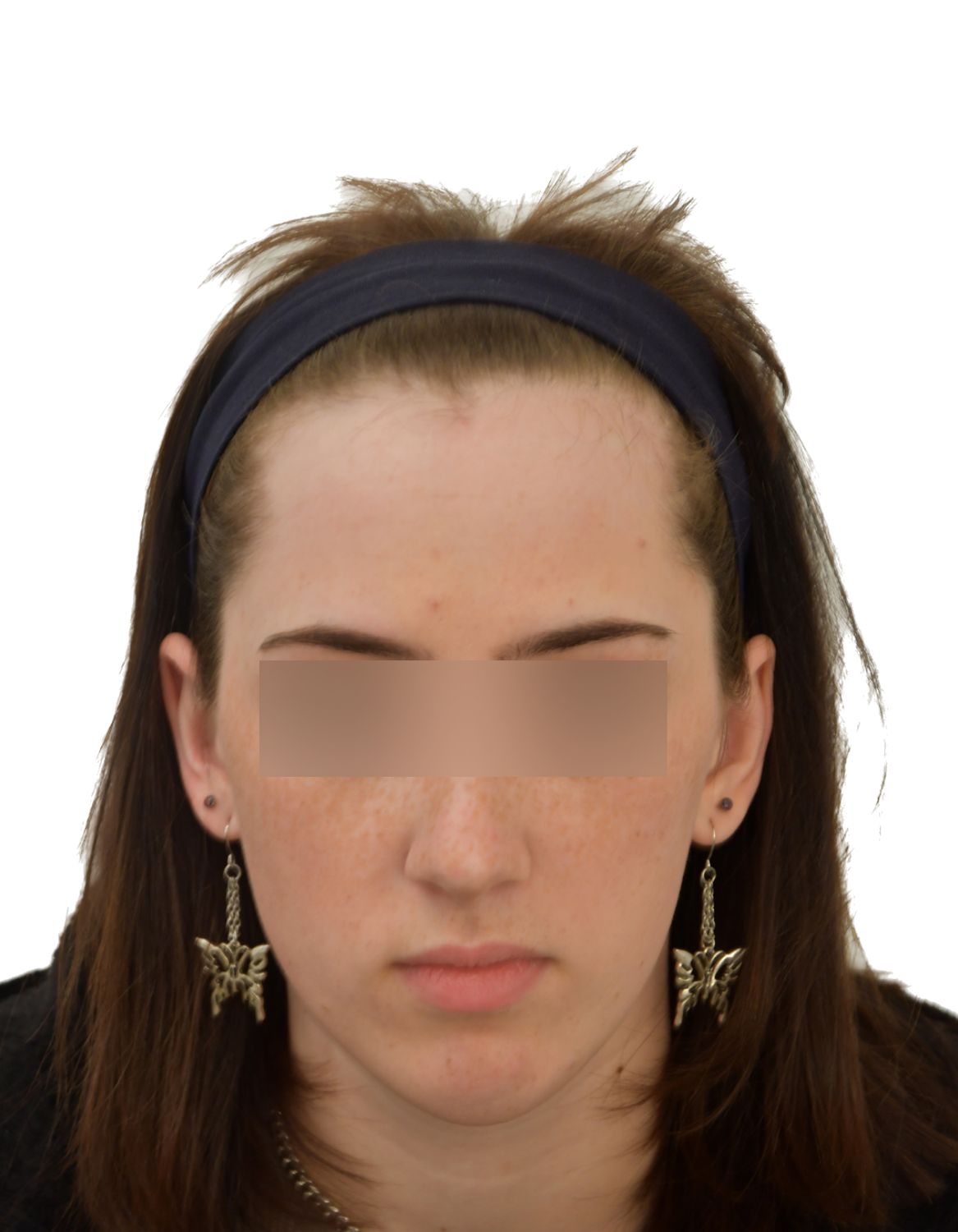 Forehead Reduction Surgery Before