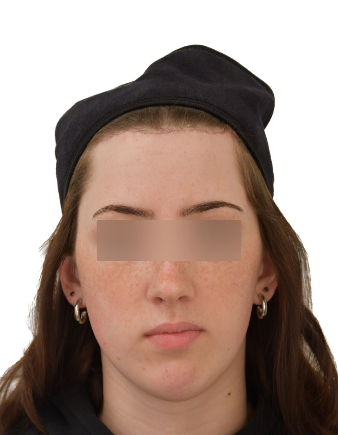 Forehead Reduction Surgery After