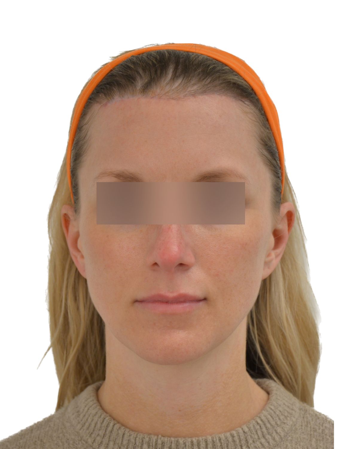 Forehead Reduction Surgery After