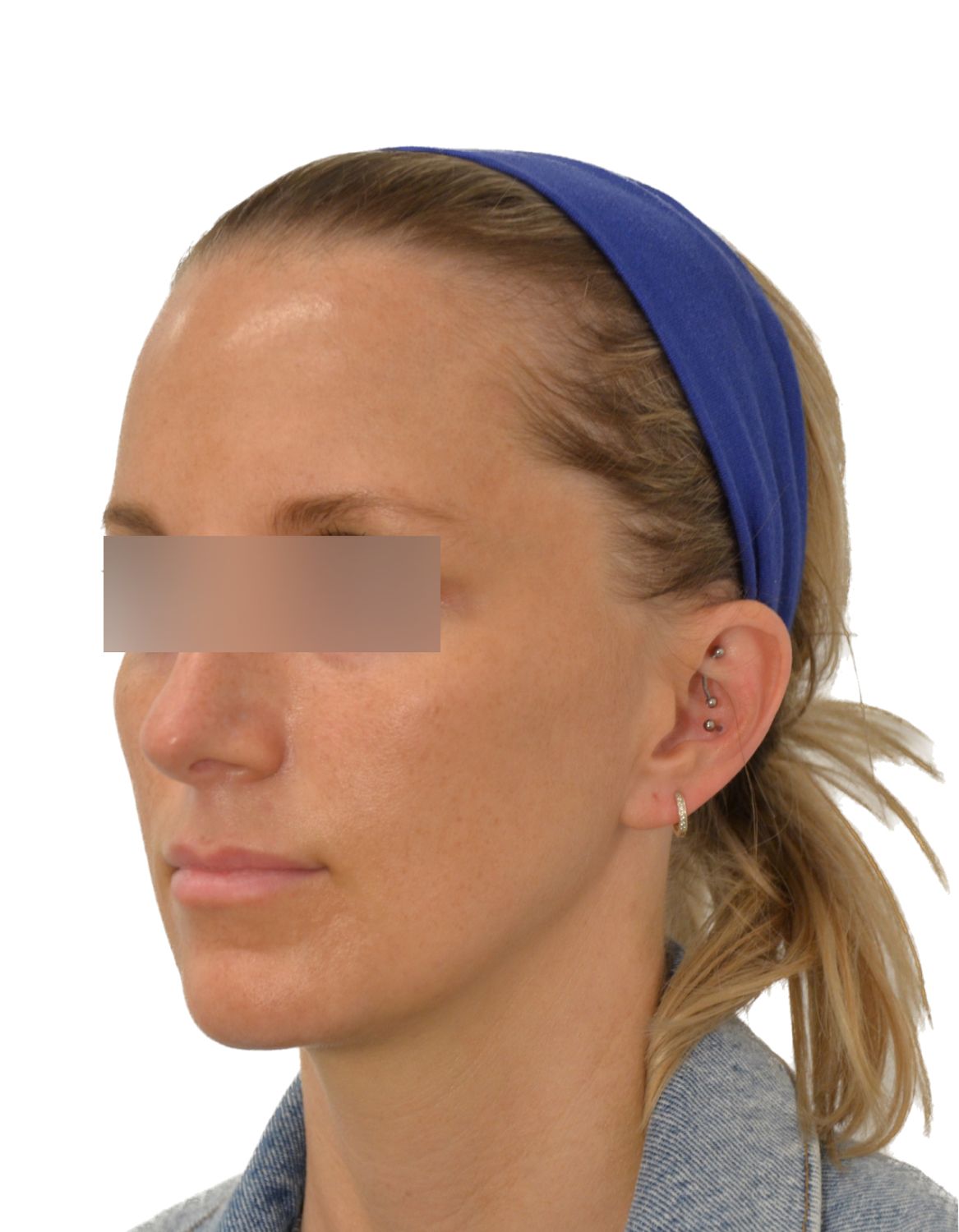 Forehead Reduction Surgery Before