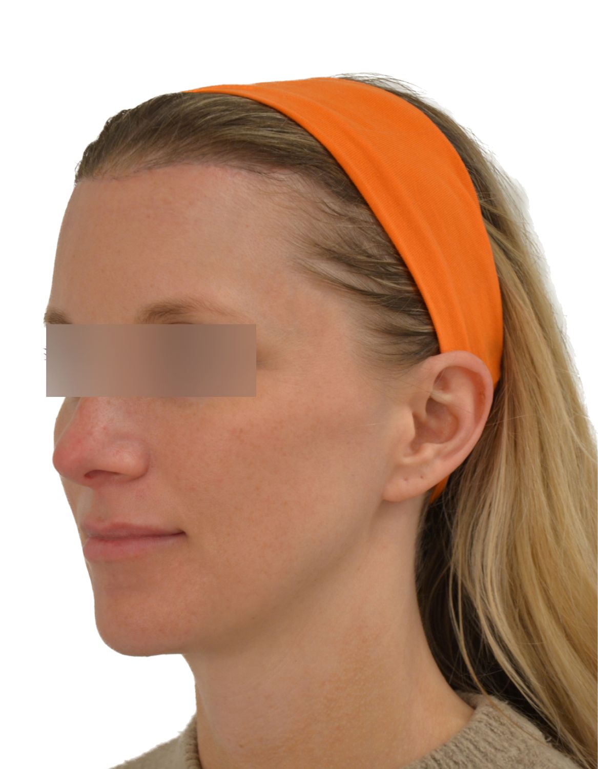 Forehead Reduction Surgery After