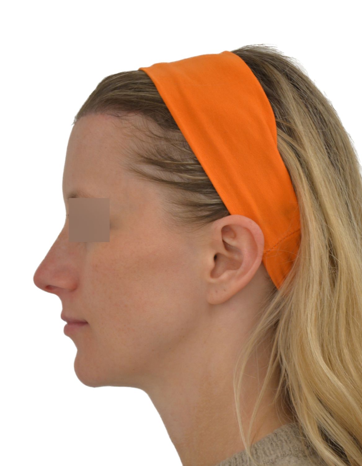 Forehead Reduction Surgery After