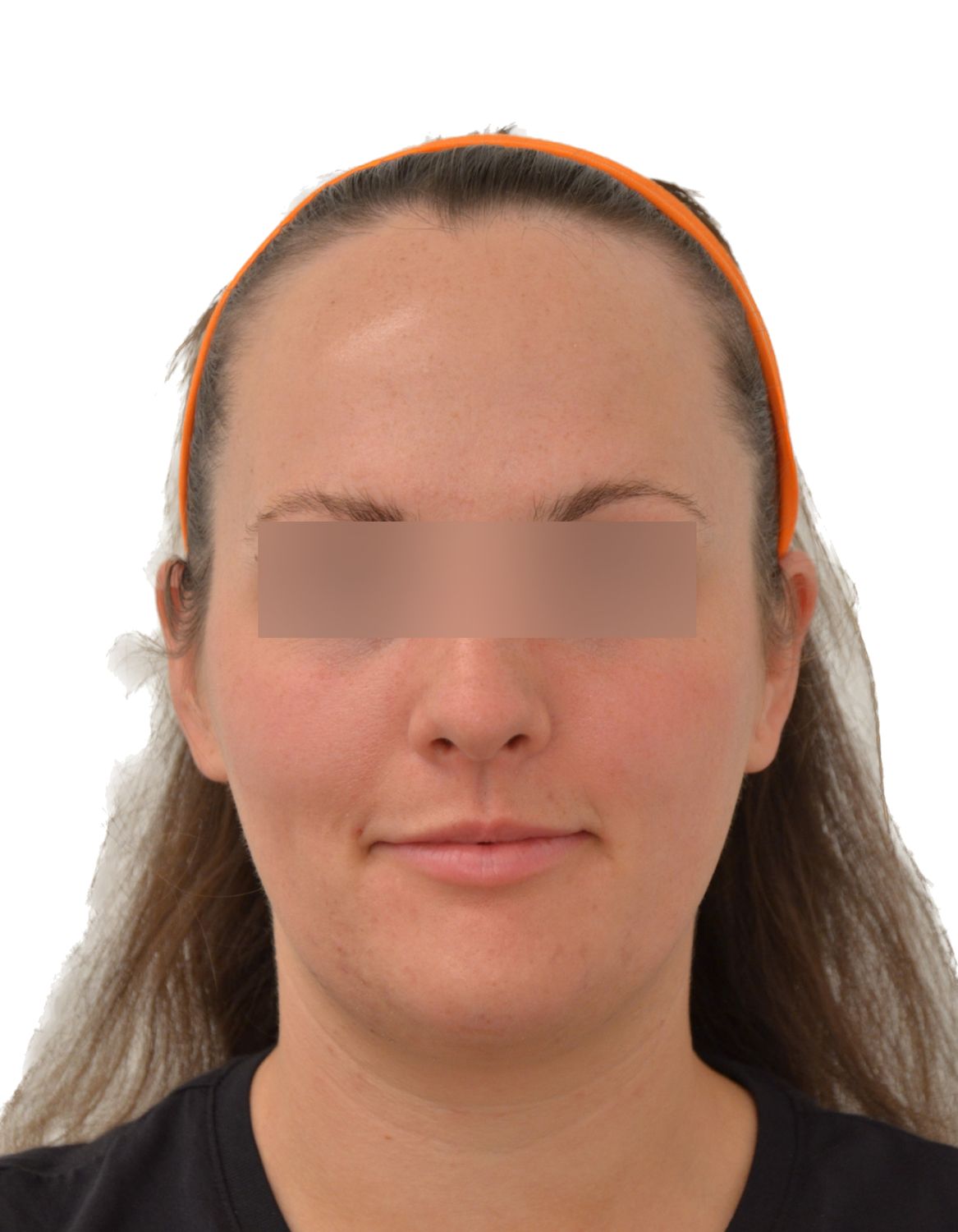 Forehead Reduction Surgery Before