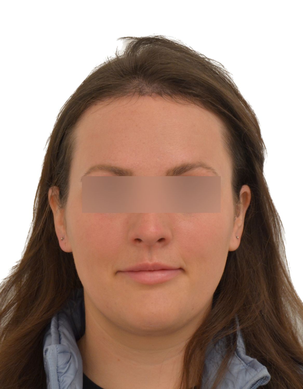 Forehead Reduction Surgery After