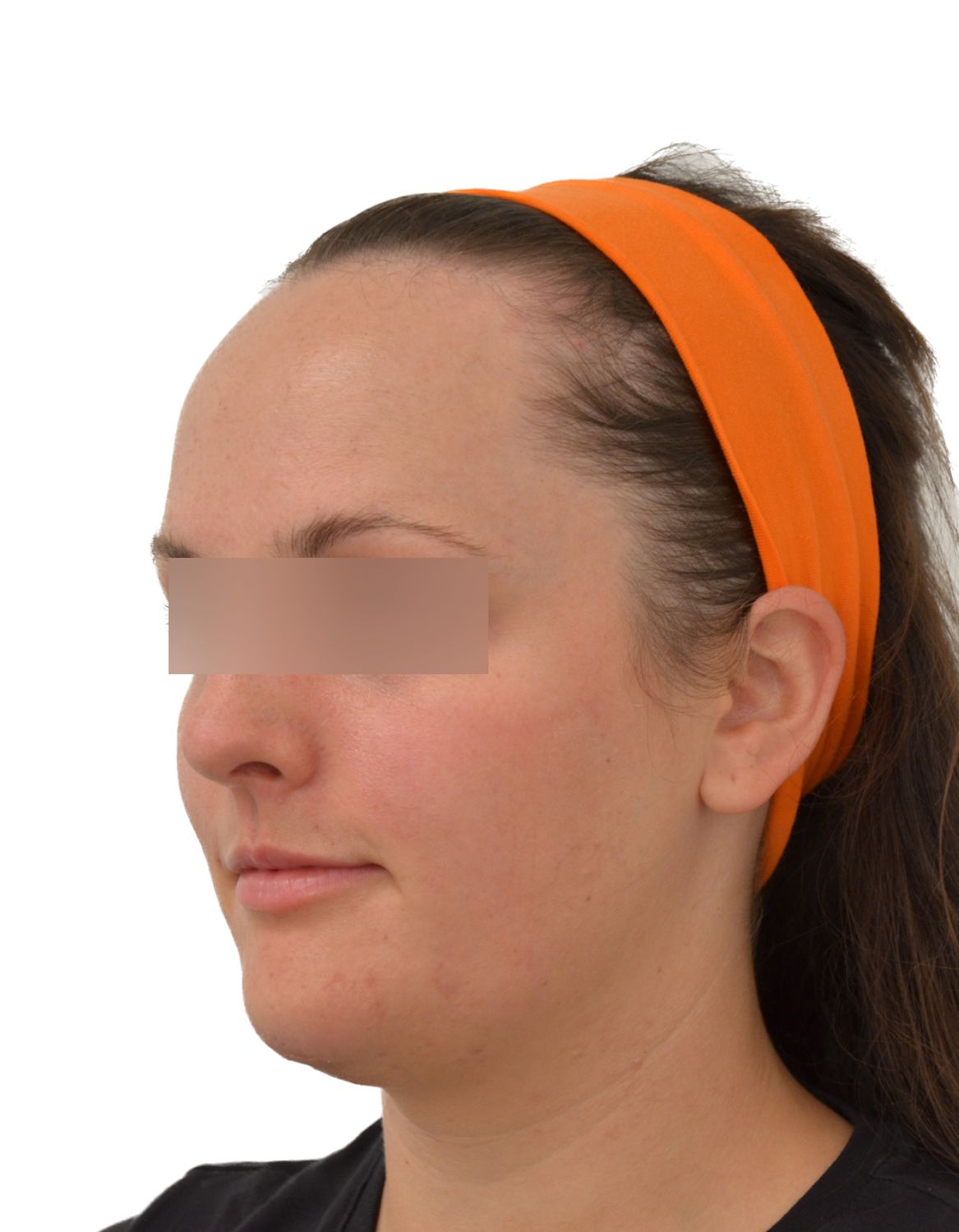 Forehead Reduction Surgery Before