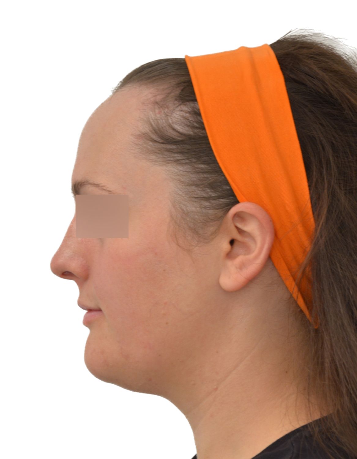 Forehead Reduction Surgery Before