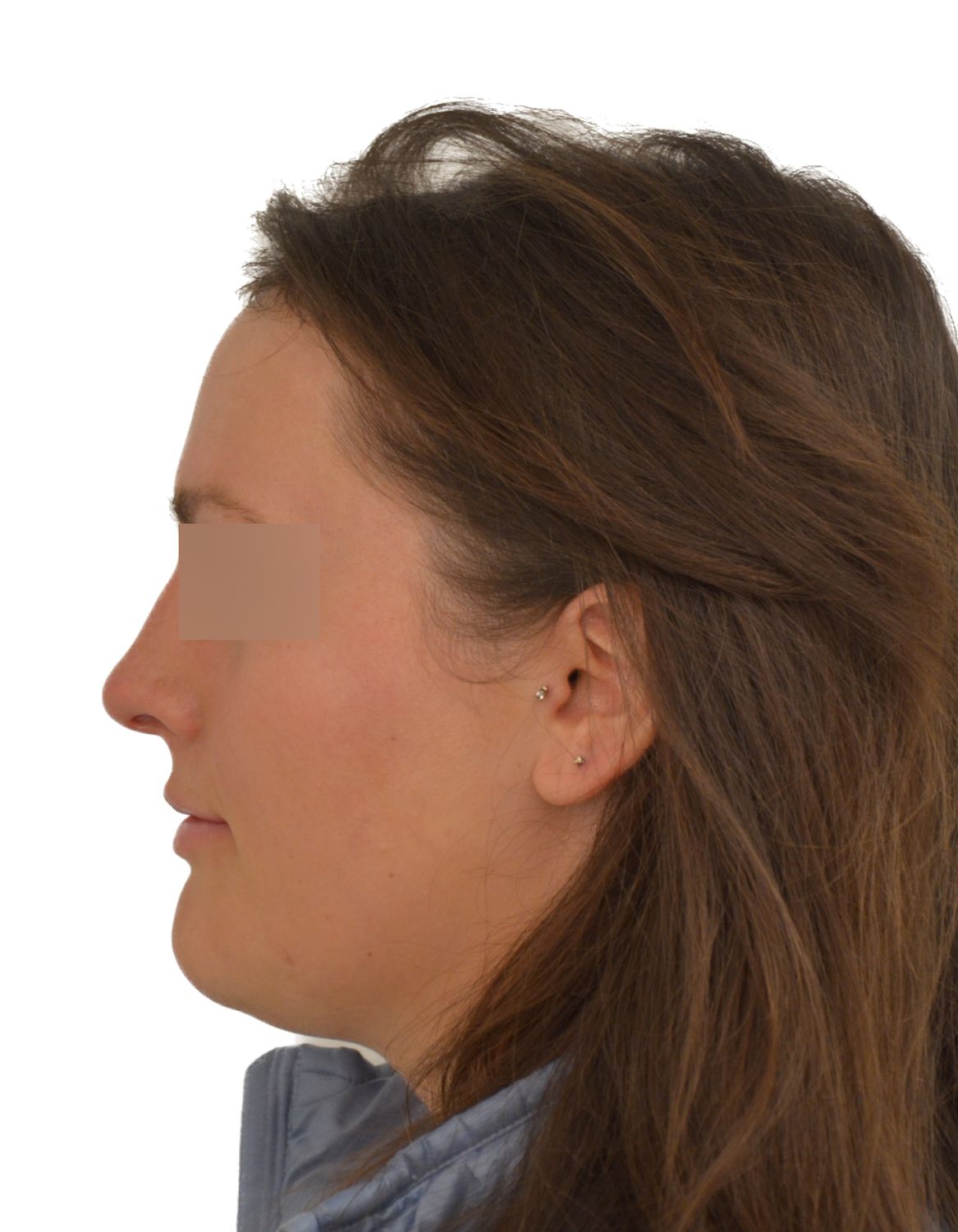 Forehead Reduction Surgery After