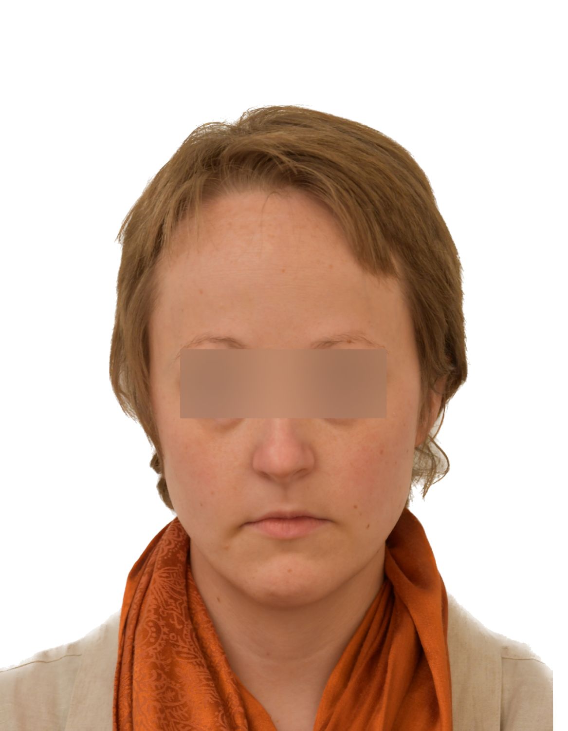 Forehead Reduction Surgery Before