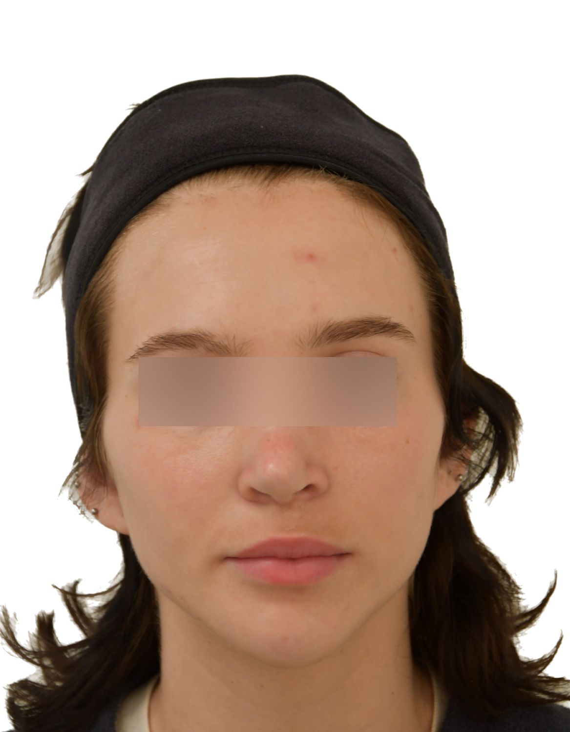 Forehead Reduction Surgery Before