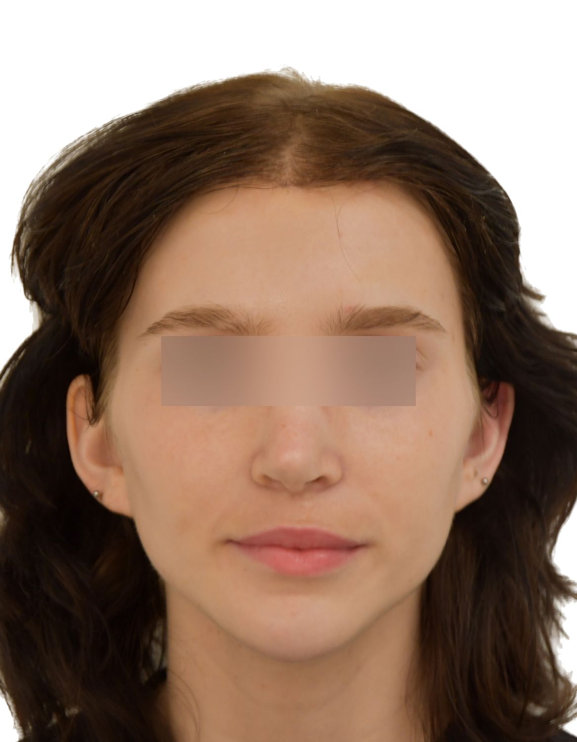 Forehead Reduction Surgery After