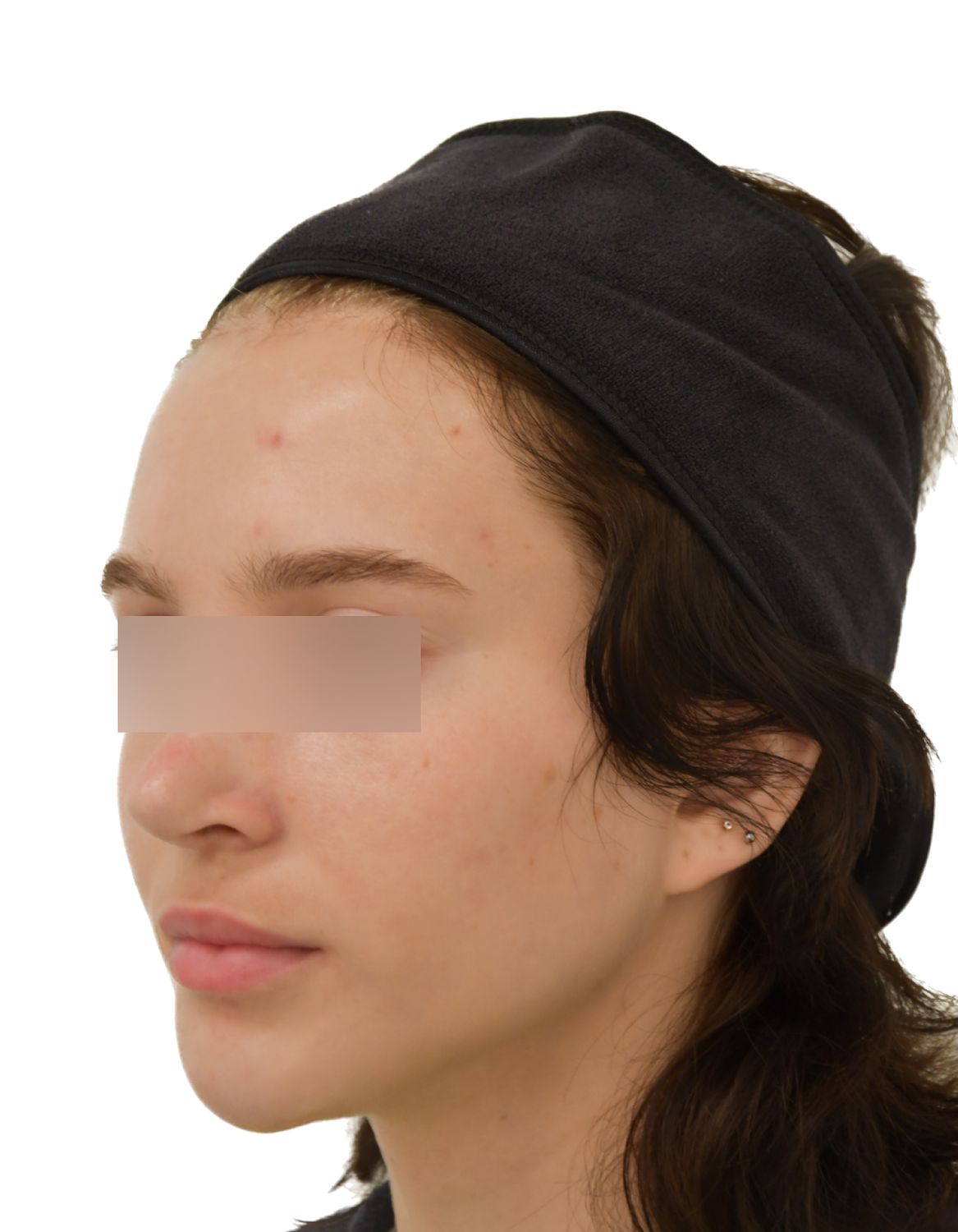 Forehead Reduction Surgery Before