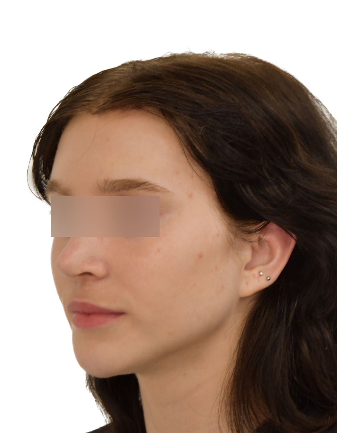 Forehead Reduction Surgery After