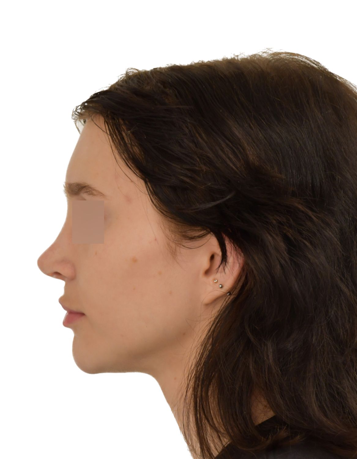 Forehead Reduction Surgery After