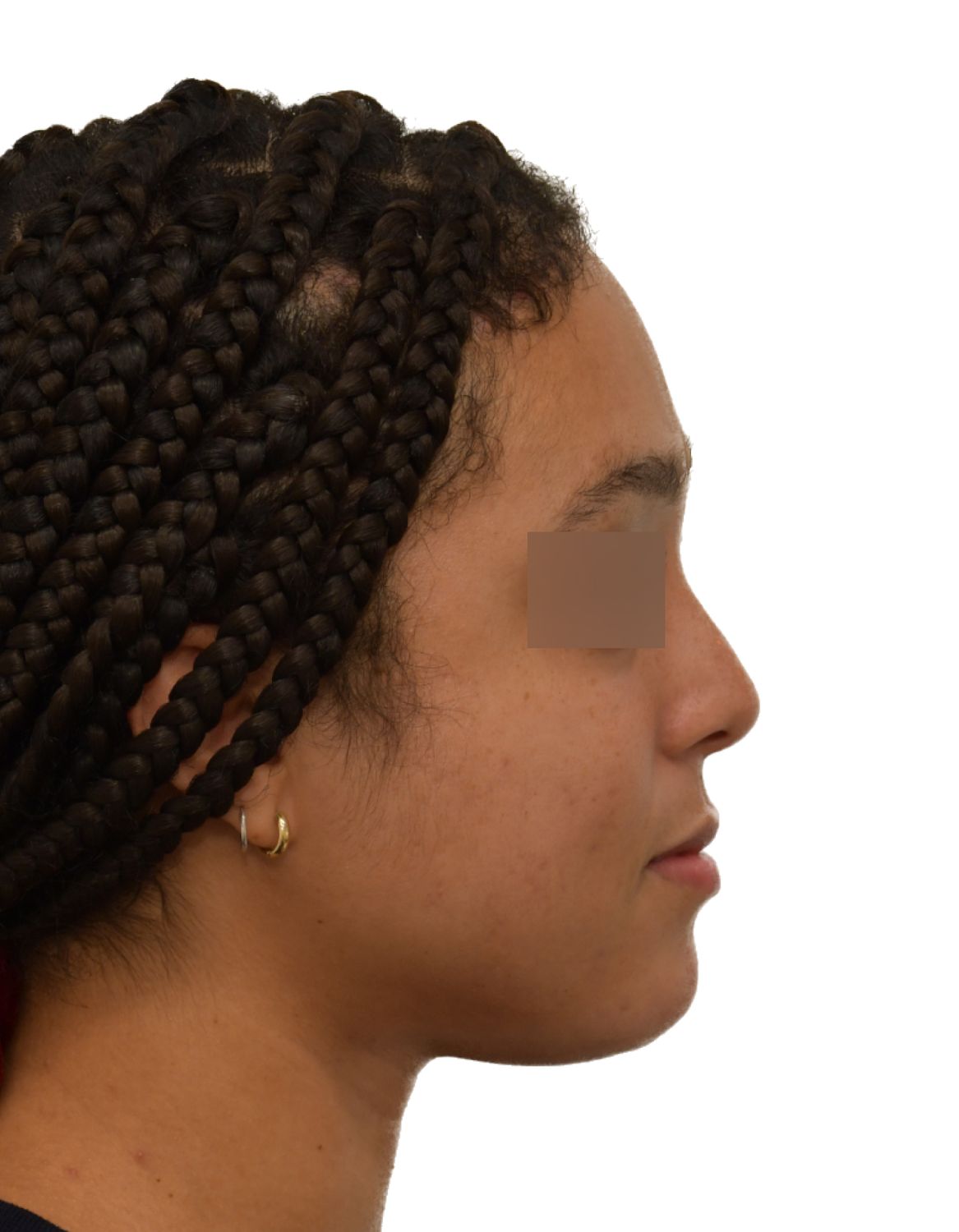 Forehead Reduction Surgery Before